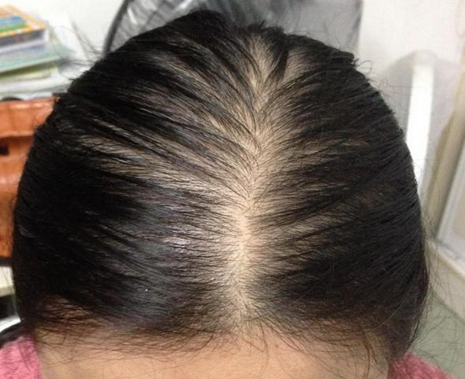 朋友生完孩子几个月,头发大把脱落,她很担心自己会变成秃子,她问:"