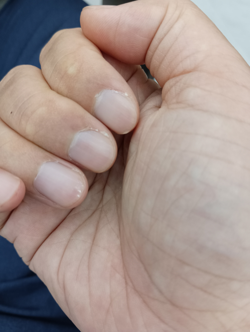 最近无名指指甲变这样,好像涂过指甲油一般闪亮,这是什么情况?