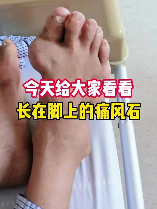今天给大家看看,长在脚上的痛风石