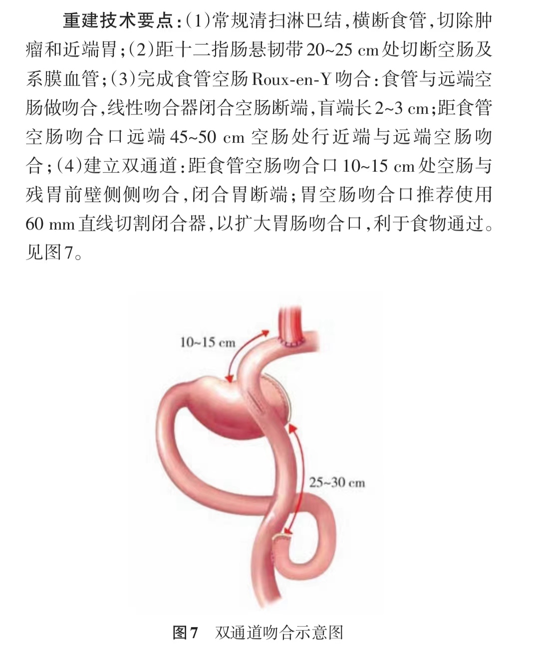 进展期胃癌根治术常见手术方式及消化道重建