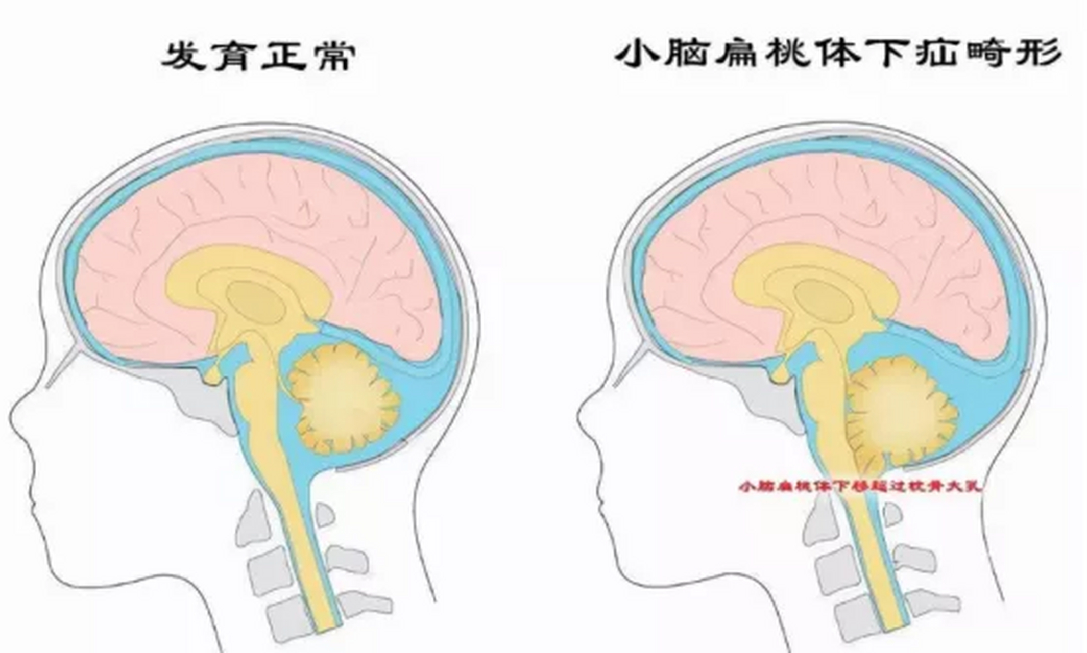 小脑扁桃体解剖图图片