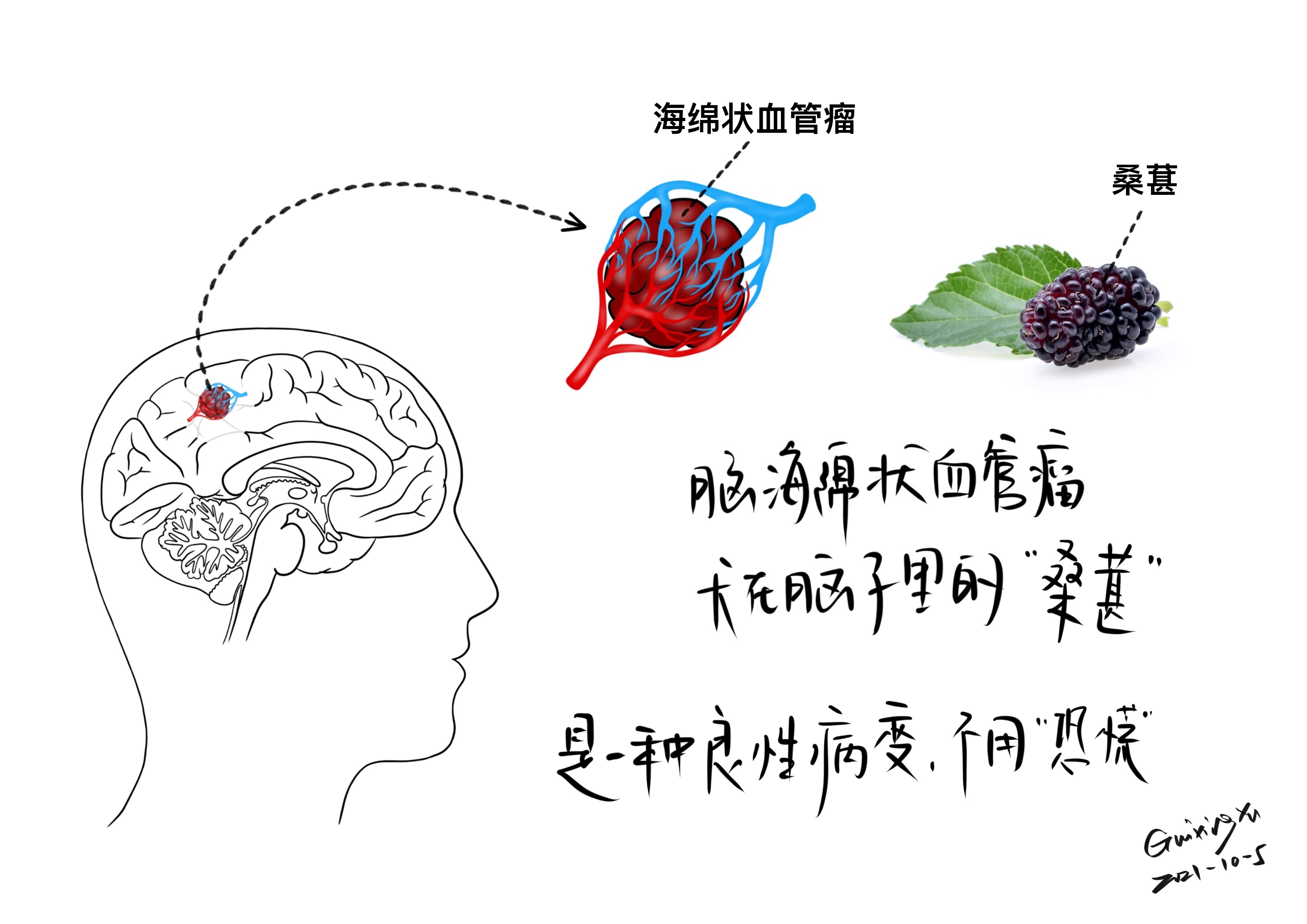 手绘:海绵状血管瘤 海绵状血管瘤,是一种良性病变,由薄层内皮细胞组成