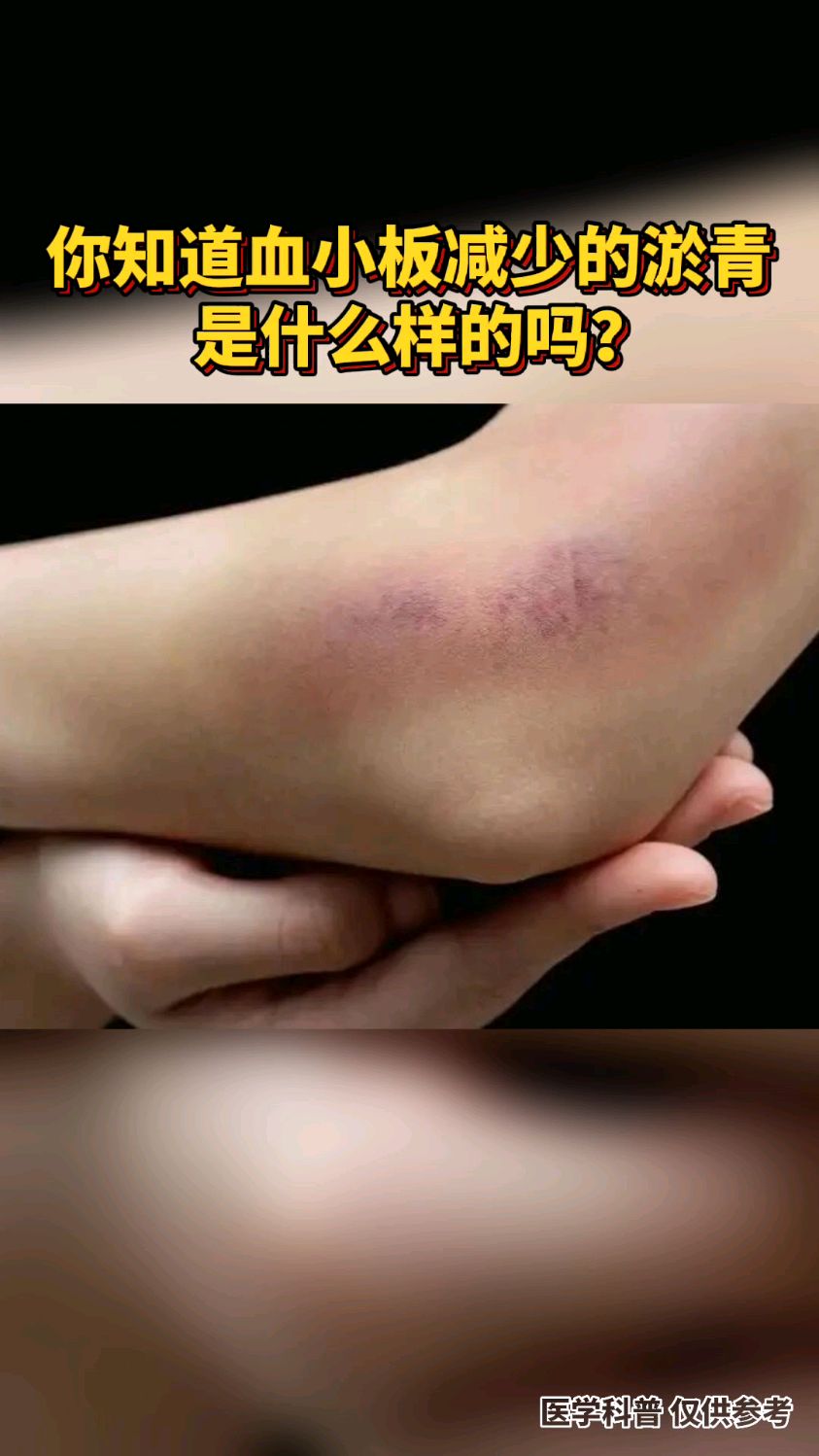你知道血小板减少的淤青是什么样的?