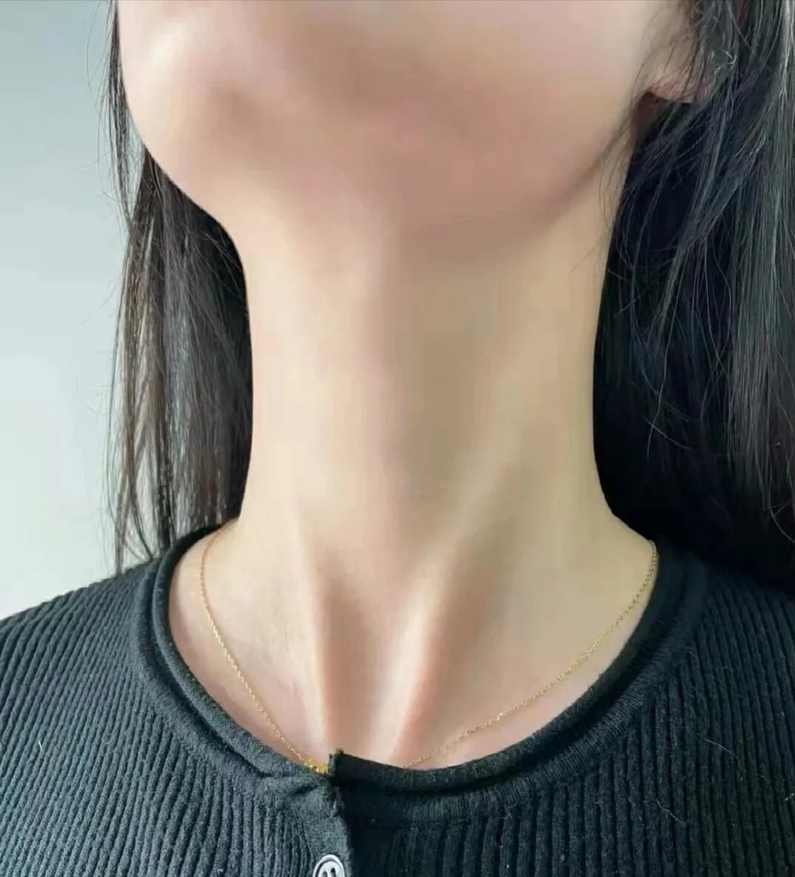 成功摆脱了甲亢脖粗困扰!