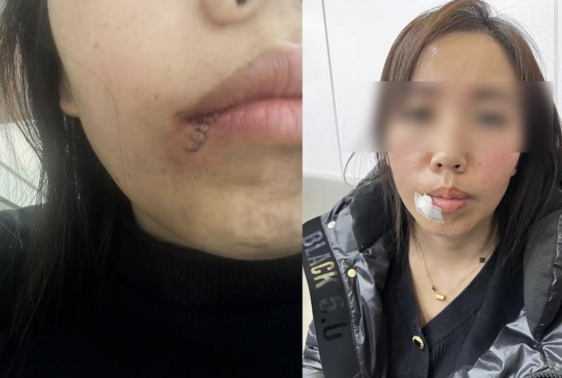 近日,闫女士在榆林二院拔智齿时,竟然被医生李某的手术刀不慎割伤