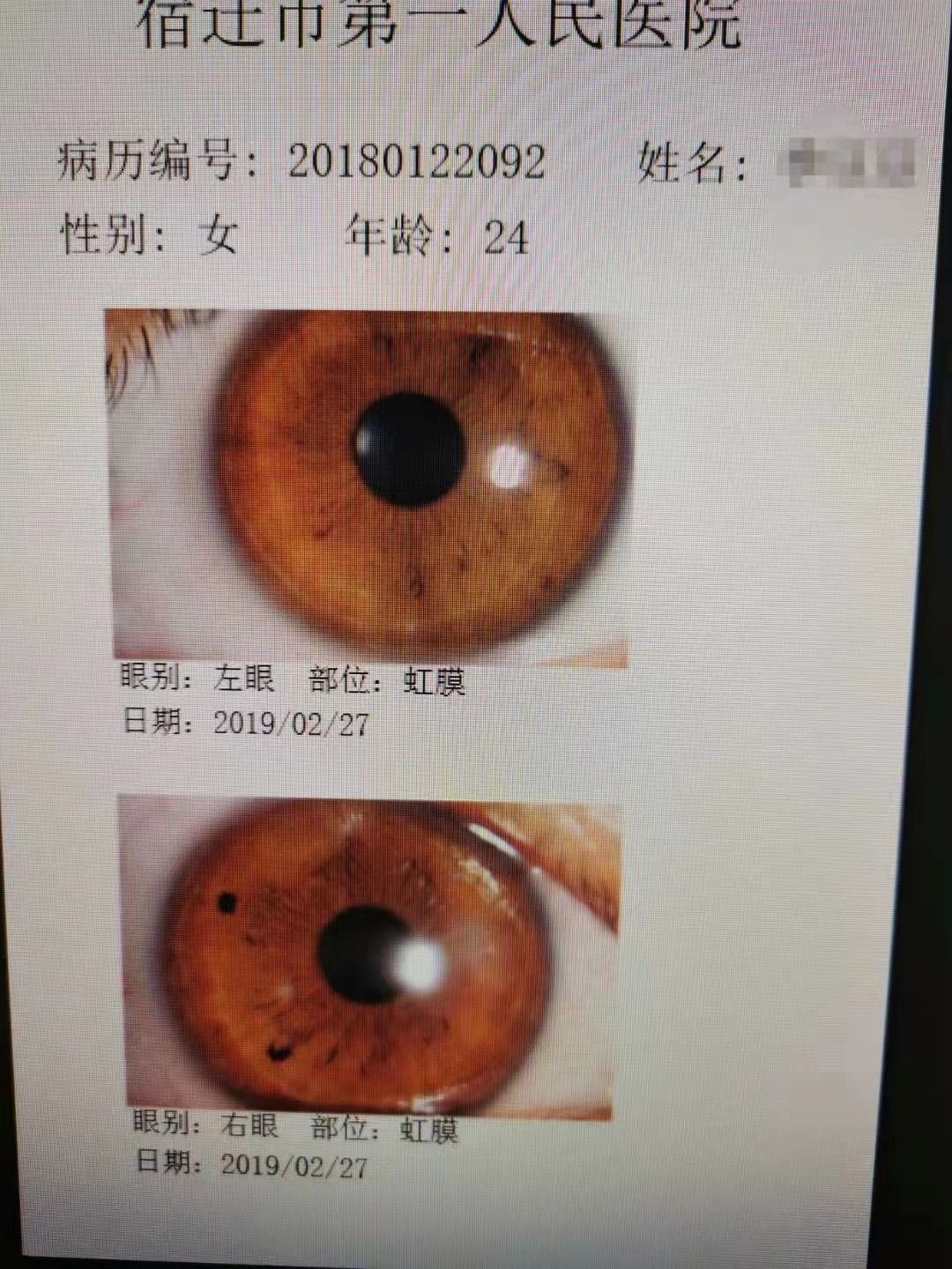 眼科门诊故事——角膜反复糜烂的病因