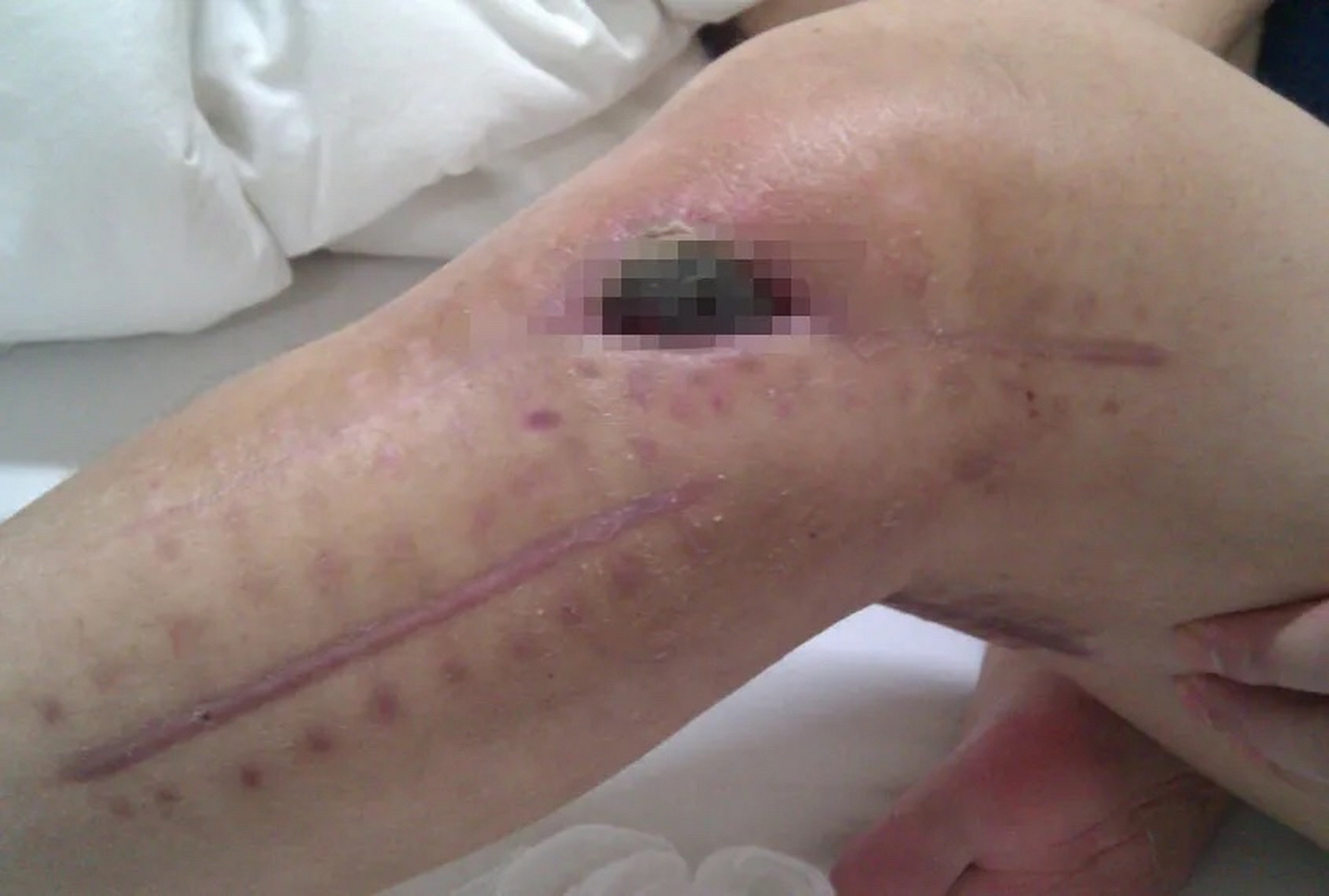 我老公前年骑摩托车跑山出了车祸,腿上打了钢板,是进口的,花了3万多