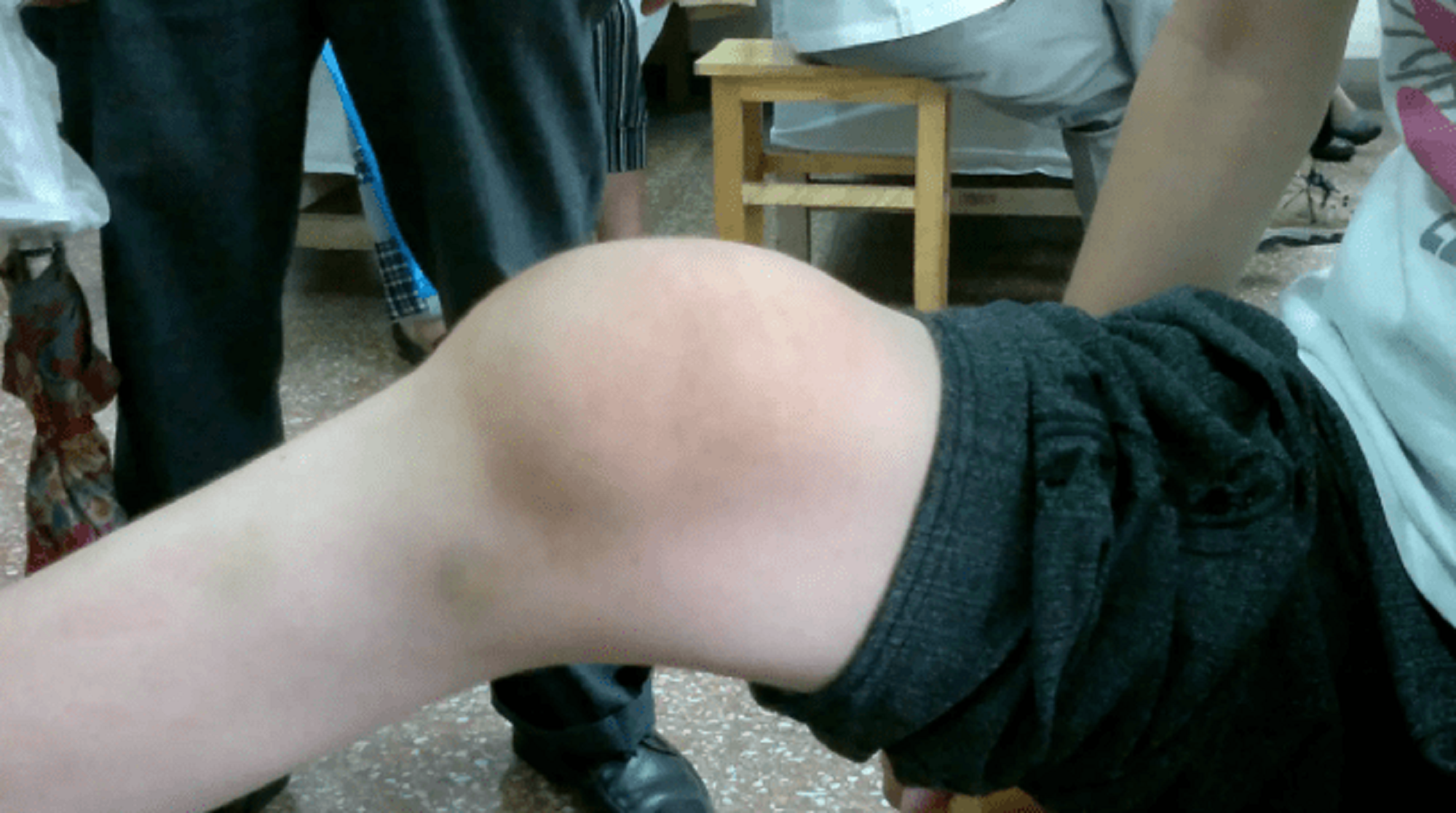 膝关节肿胀积液怎么办?过来人分享康复经验,滑膜炎在家摆脱!