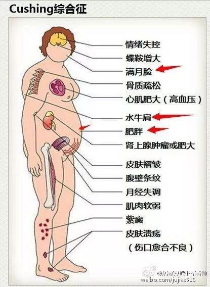 皮质醇增多症图片图片