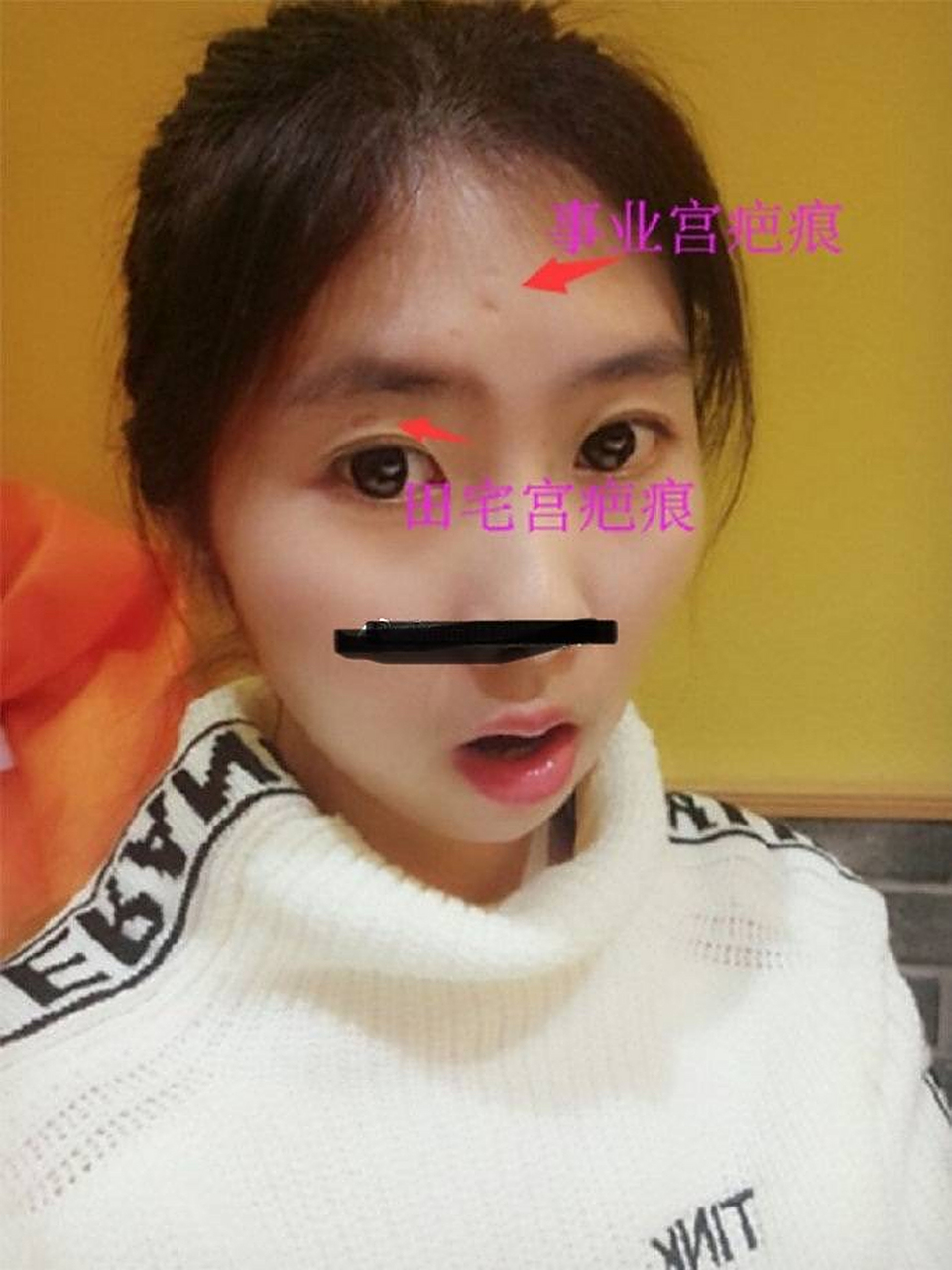 "事业宫"以及"田宅宫"出现明显疤痕,这不仅是早年运势极为不利的征兆