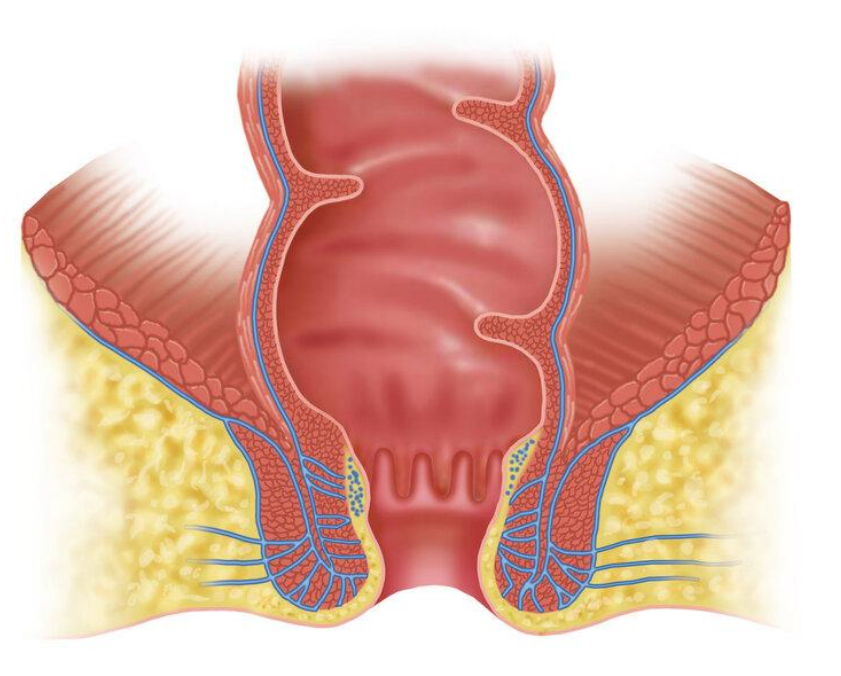 肛管癌痔疮图片