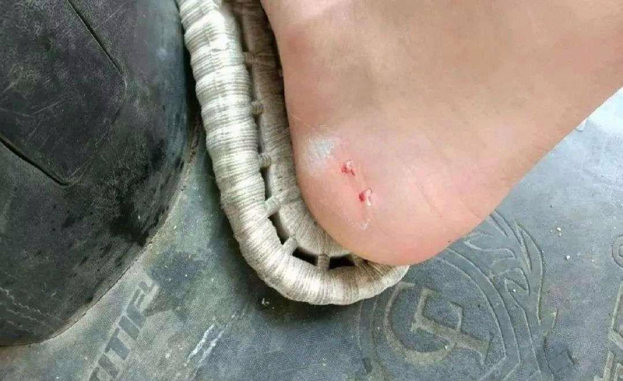 被不知名的蛇咬伤了,要不要紧啊