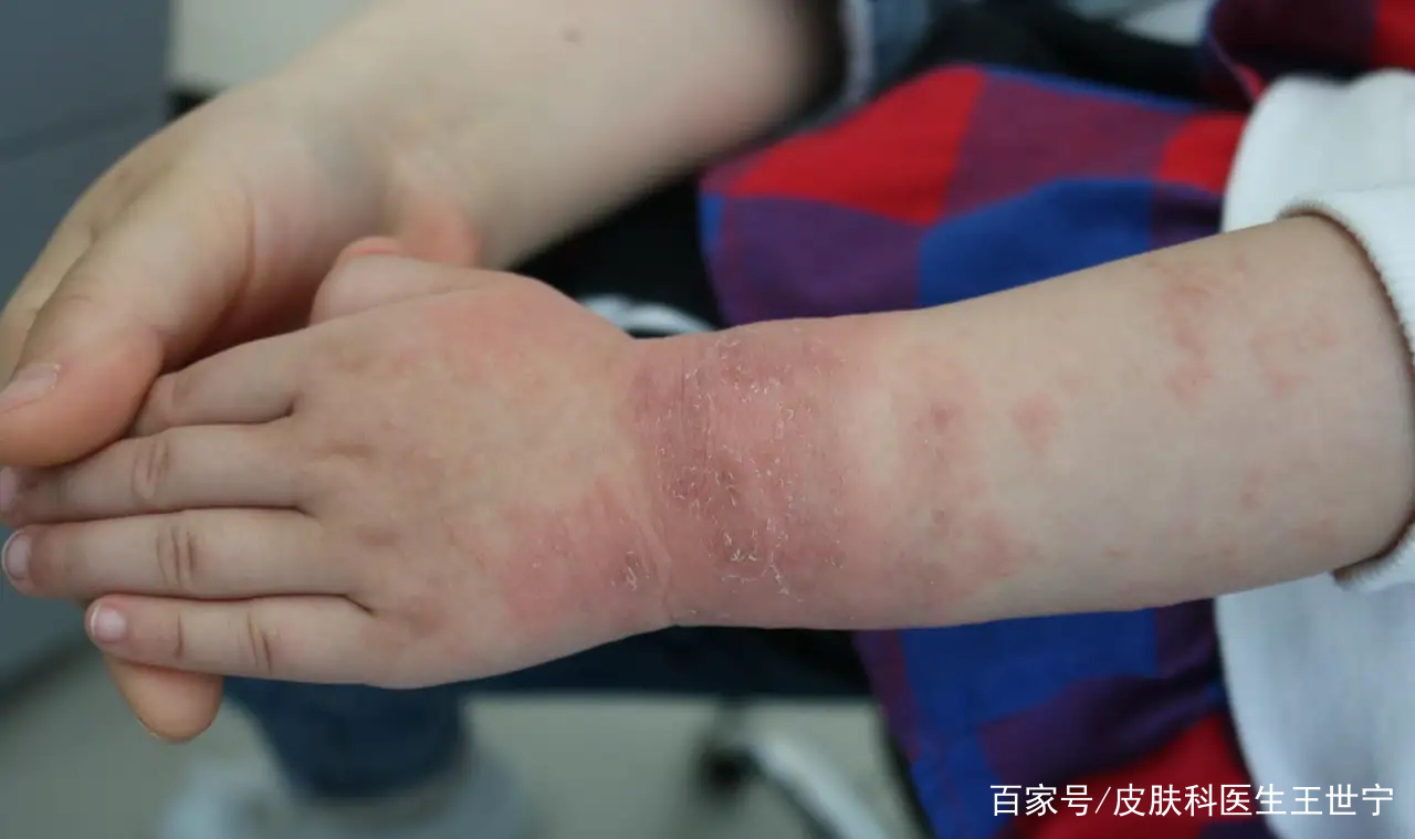什么是接触性皮炎 baijiahao.baidu.com