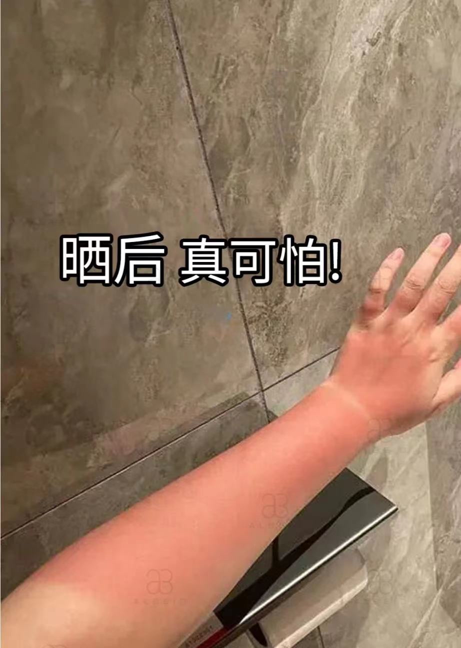 夏天都去海边玩,可晒伤了之后有什么措施呢?