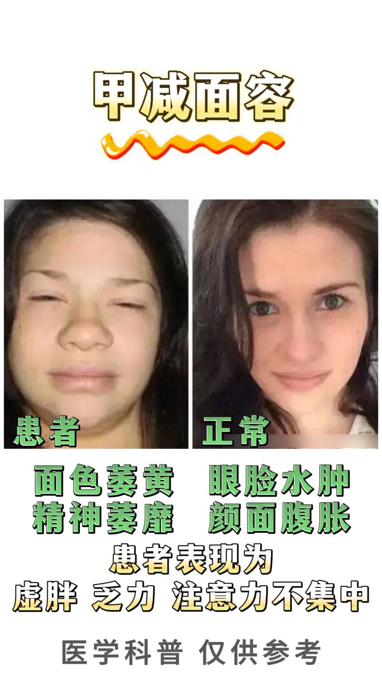 甲减甲亢严不严重看脸就知道