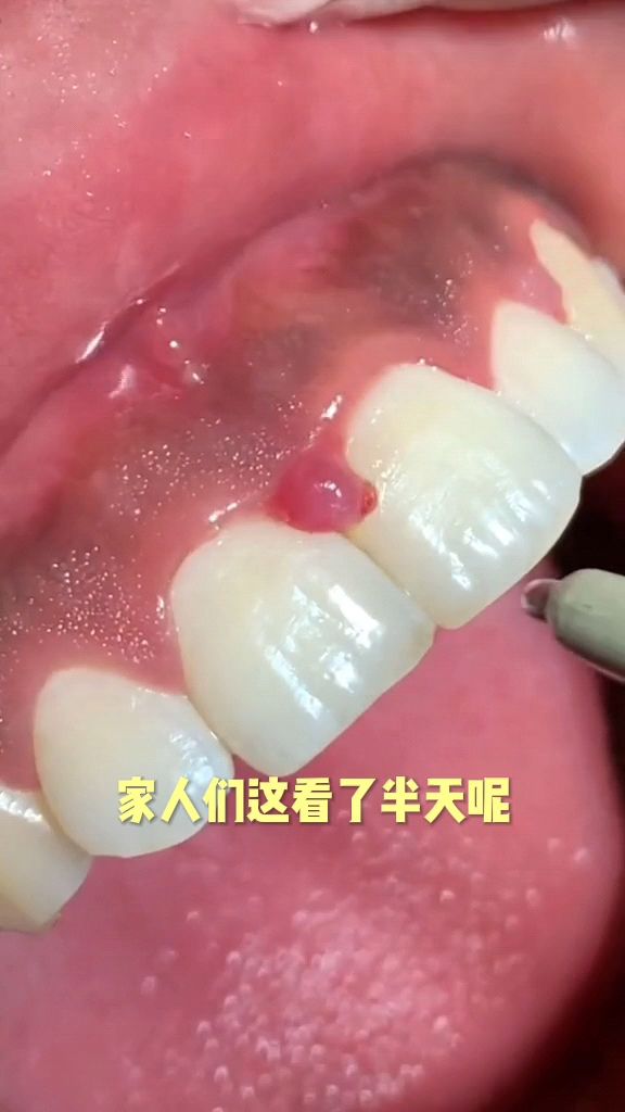 牙挺白,牙床子确黑!