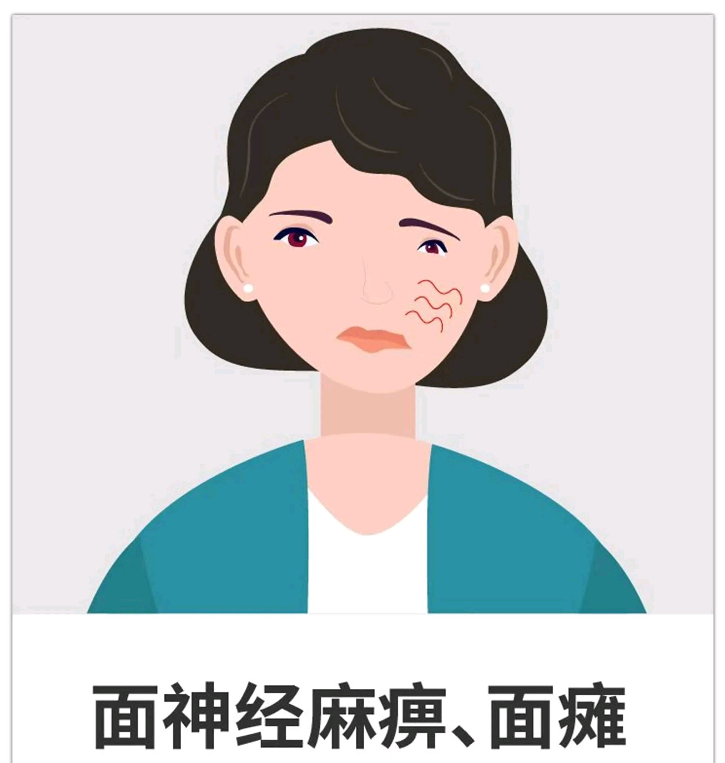 面瘫为何分型论治?