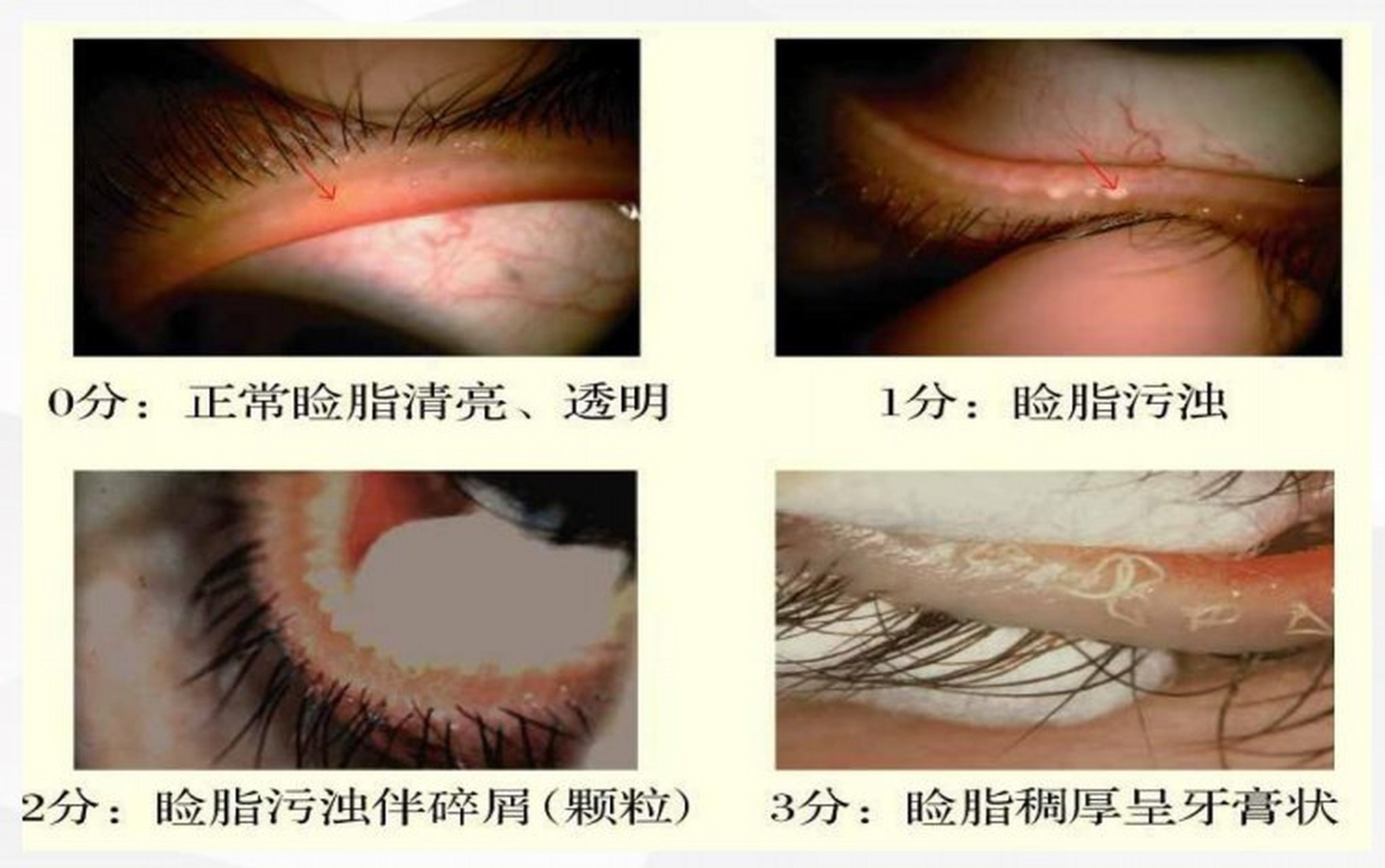 睑板腺分泌的油脂,你的可以评几分?