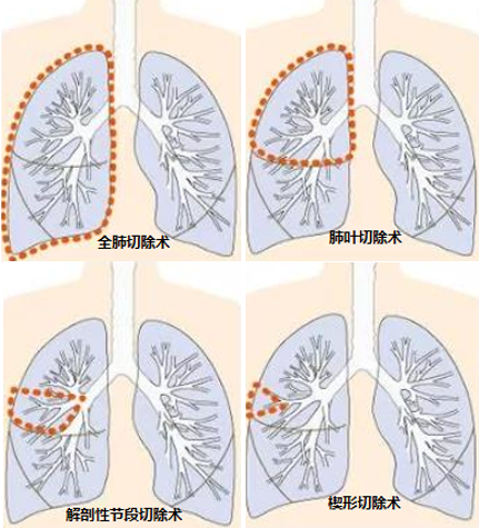 肺袖状切除术示意图图片