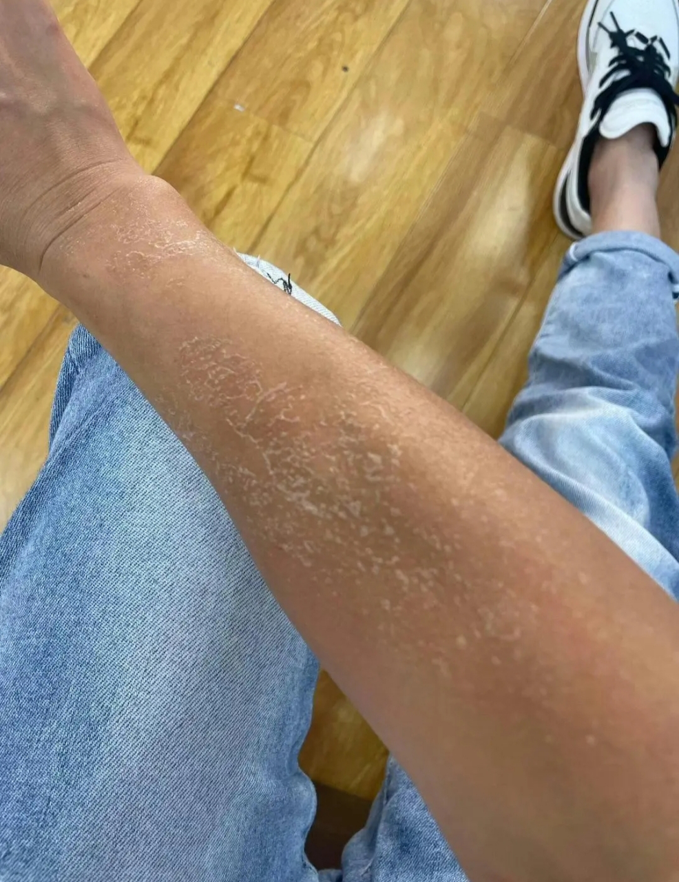 每年到冬天胳膊都会大量掉皮,这是不是一种病啊?
