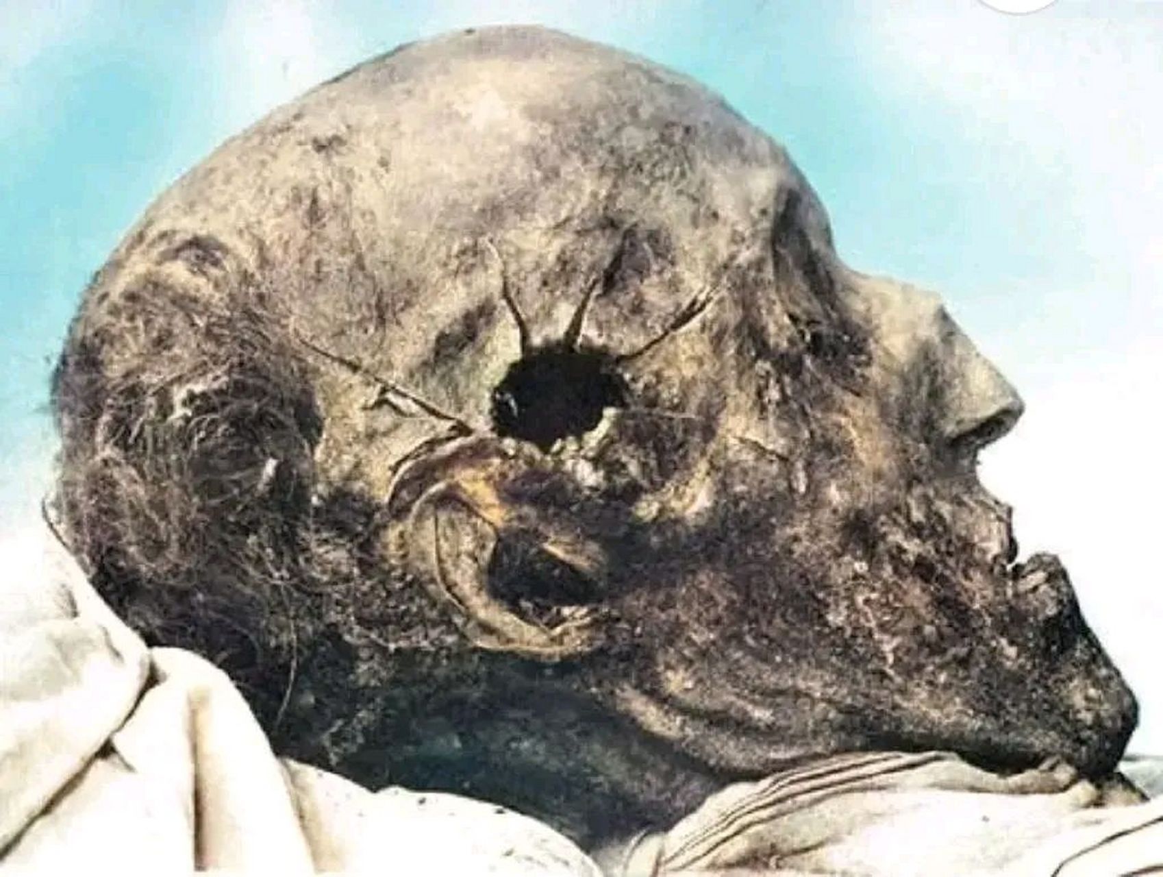 1917年,瑞典国王"卡尔十二世"尸检时,拍摄下的一张罕见老照片,从他