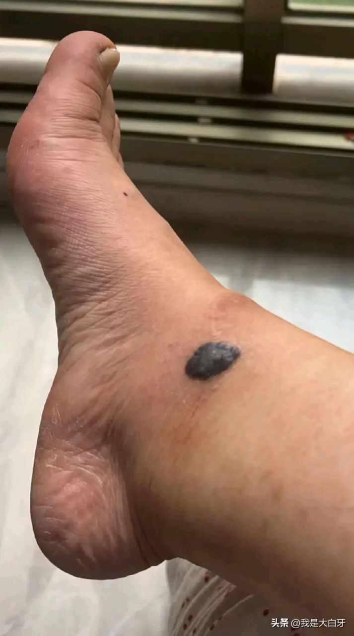 一定要去医院皮肤科做检查  我脚上长了一个黑色的痣,不疼不痒,去医院