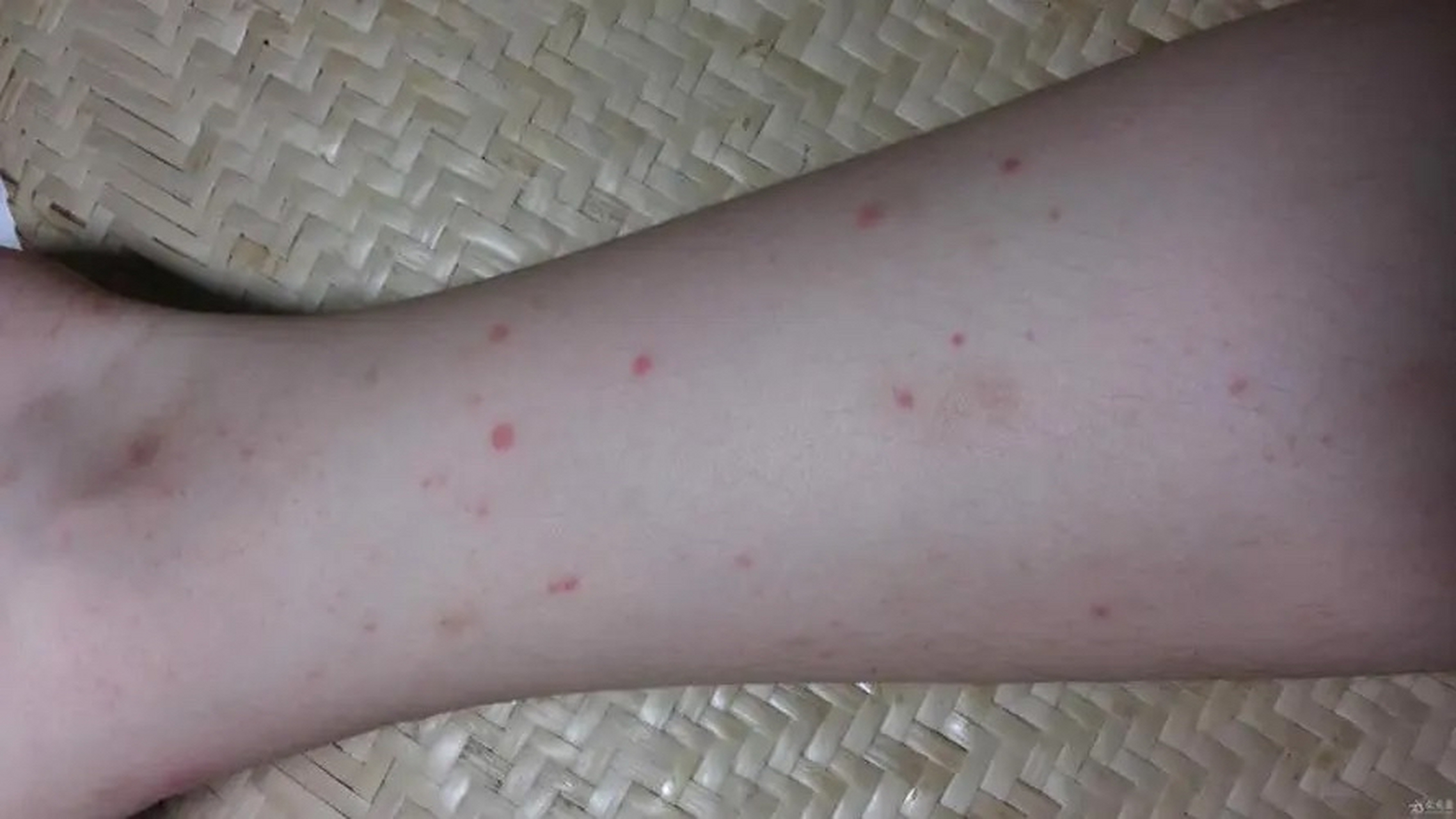 过敏性紫癜又称iga血管炎或亨-舒综合征,是一种常见的血管变态反有栽