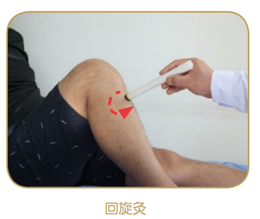 艾条灸:回旋灸法