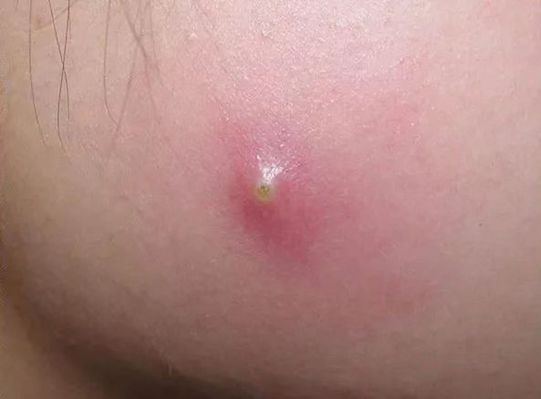 脸上长了个毛囊炎,挤了挤,脓没挤出来,结果变大了,变成疖了.