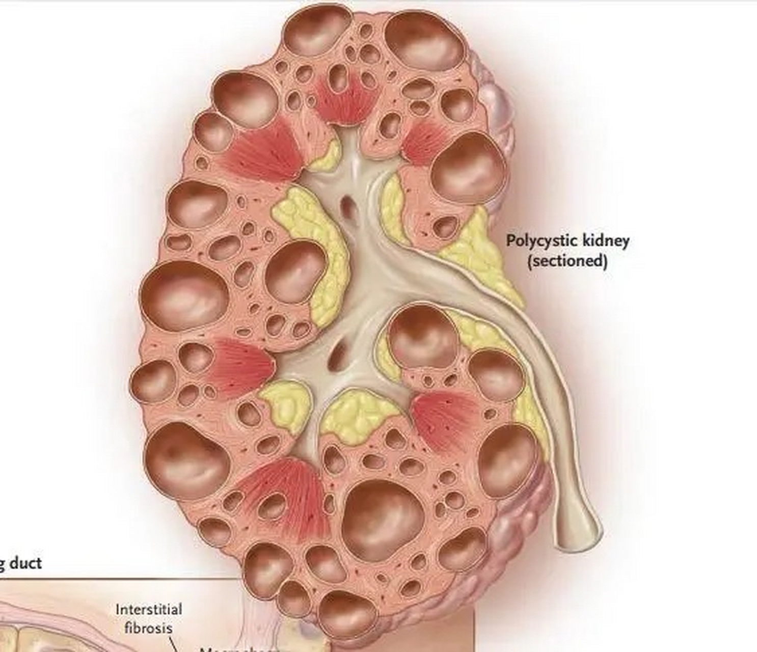 多囊肾是一组遗传异质性疾病,同时是肾衰竭的主要原因之一.