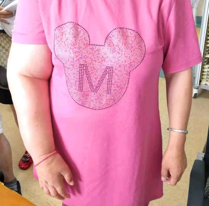 减肥能减少乳腺癌术后淋巴水肿风险吗