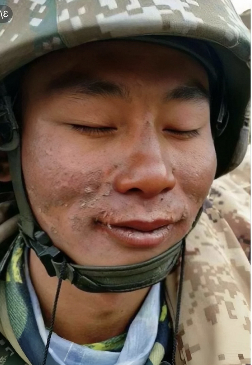 边防战士冻伤的脸图片