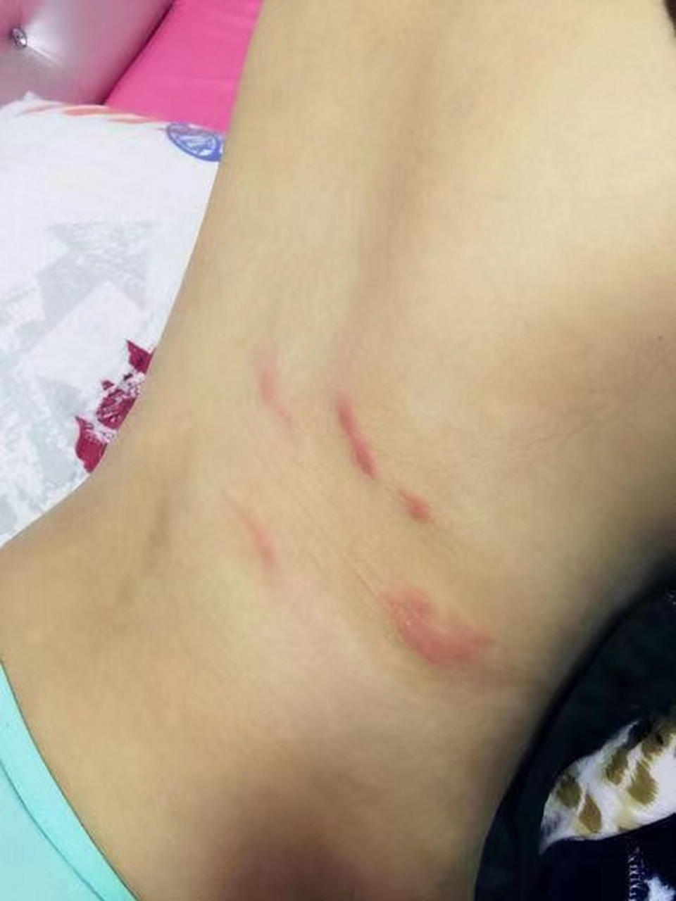 6岁宝宝被小虫子咬出红疹,医生教你这样做!