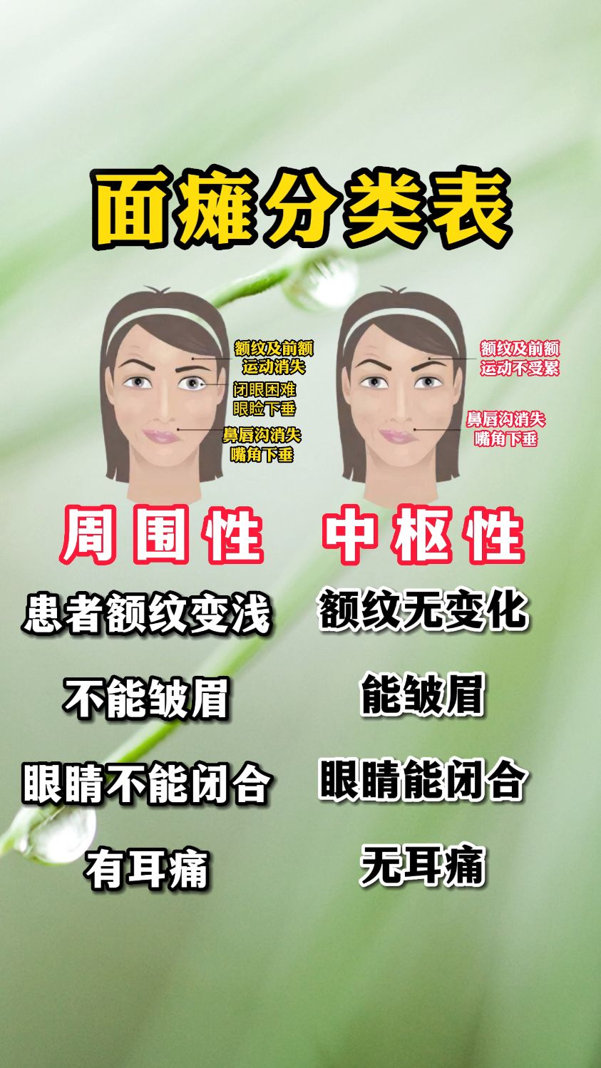面瘫分类表,看看您属于哪种类型面瘫