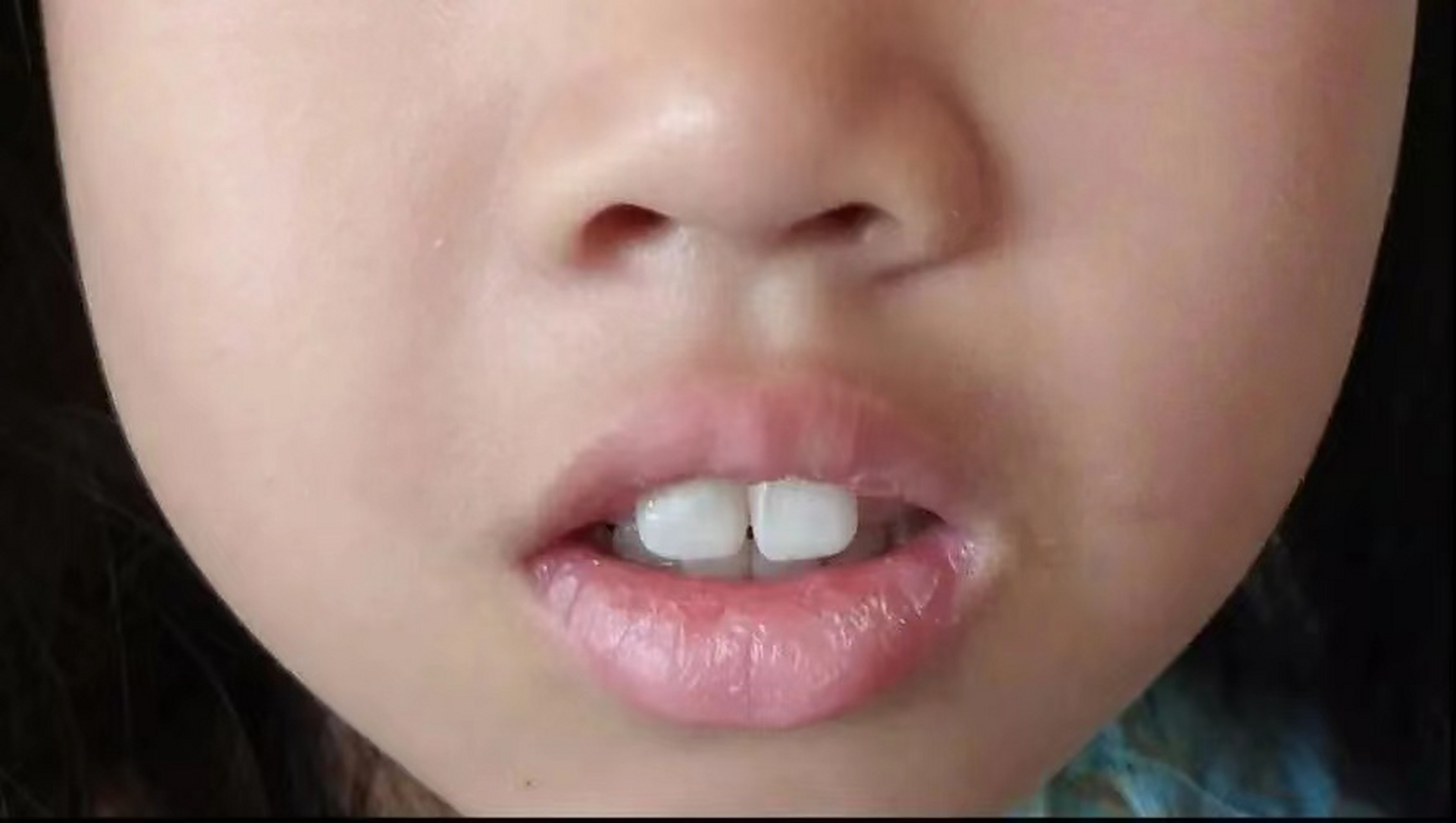 太可惜了,这个6岁女孩还是看晚了,已经出现腺样体