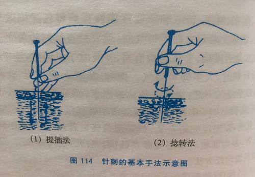 球后针刺手法示意图图片