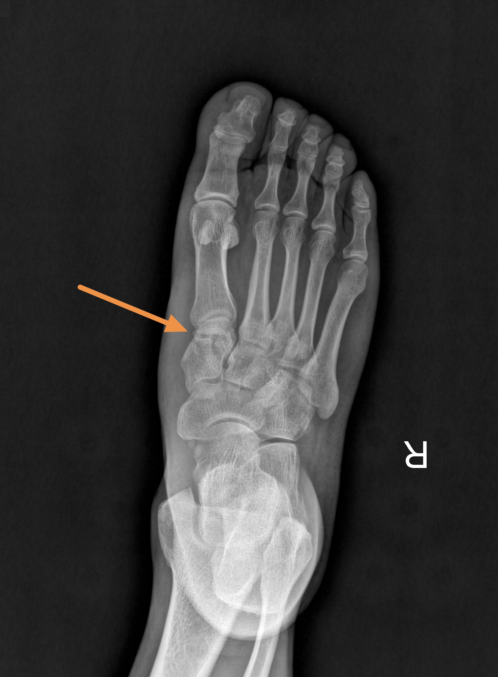 47岁,在家里打扫卫生, 拖把杆碰掉了墙上的一块砖头,掉下来砸脚背上了