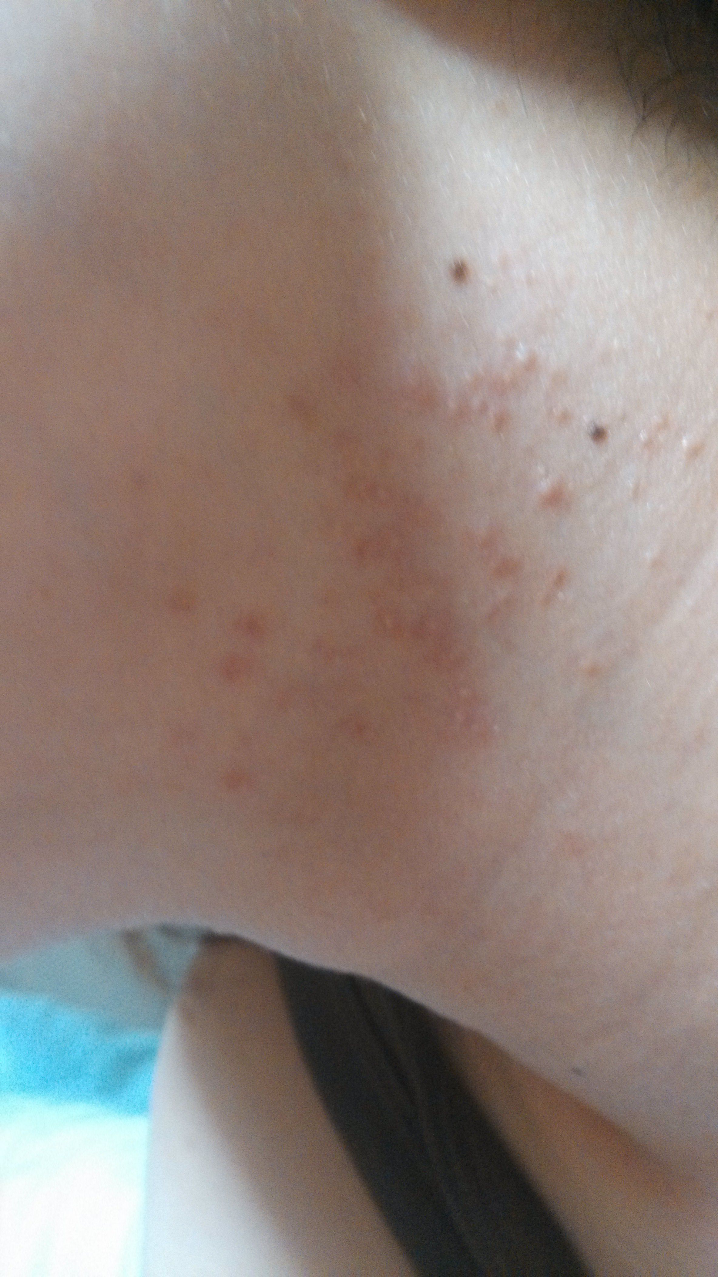 阳第三天后浑身上下过敏