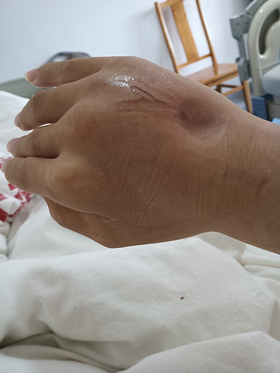 手都肿了,就像冬天里挨冻的萝卜,钻心的疼,左手换右手,右手换左手