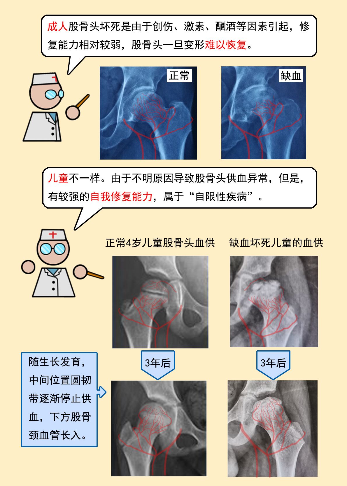 儿童股骨头缺血坏死——perthes病,极简攻略!