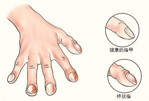 手指头肿胀是怎么回事?手指出现这种表现,可能是身体发出的信号