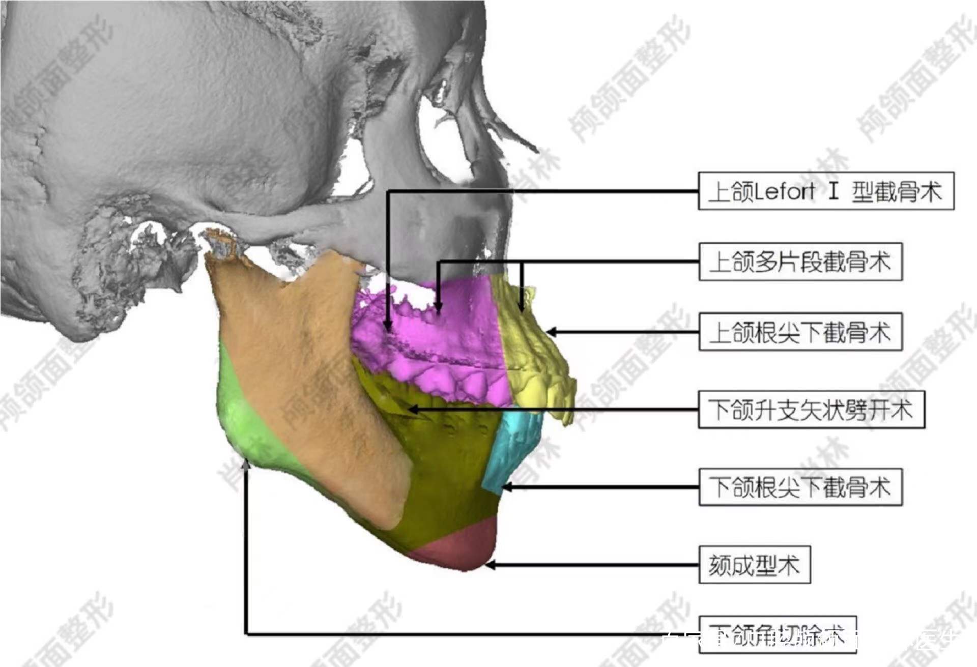 颌面外科正颌手术的常规截骨方式有哪些?科普
