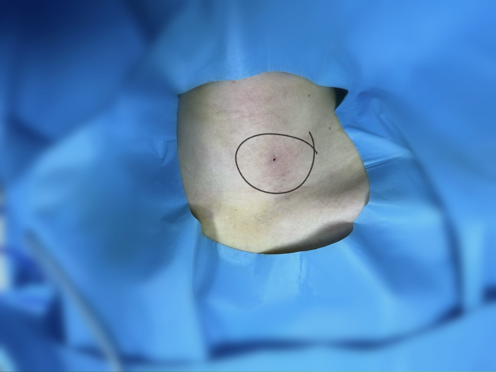 甲状腺结节微创消融治疗