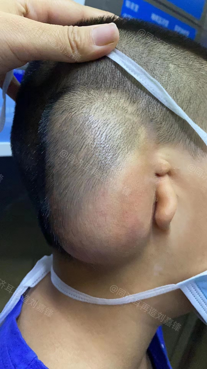 孩子今年6岁,耳朵只有一条小肉,耳道也闭锁着,属于典型的三度小耳畸形