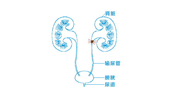 输尿管结石结构示意图图片