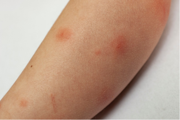 蚊子"小咬一口",为何我们的反应千差万别?