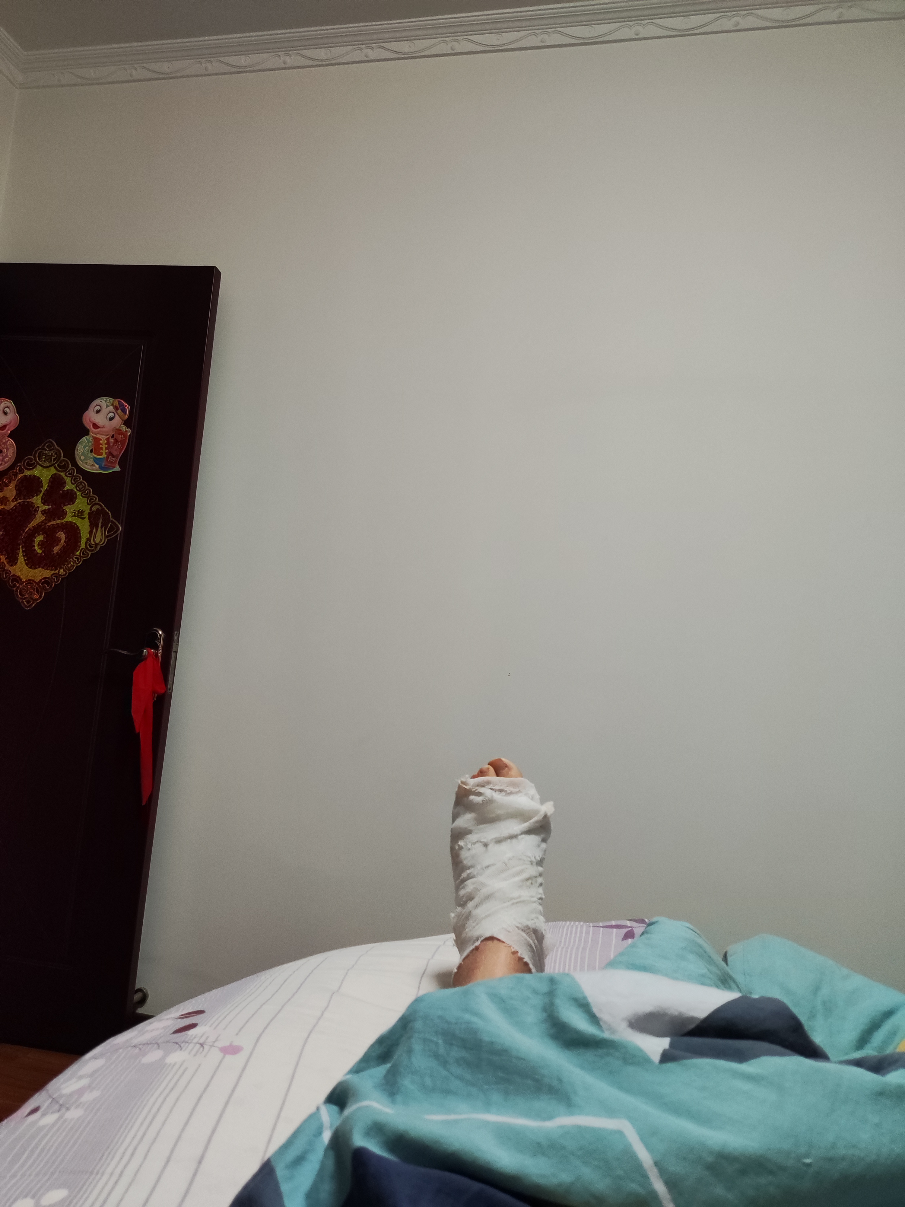 今天是脚骨折第48天了
