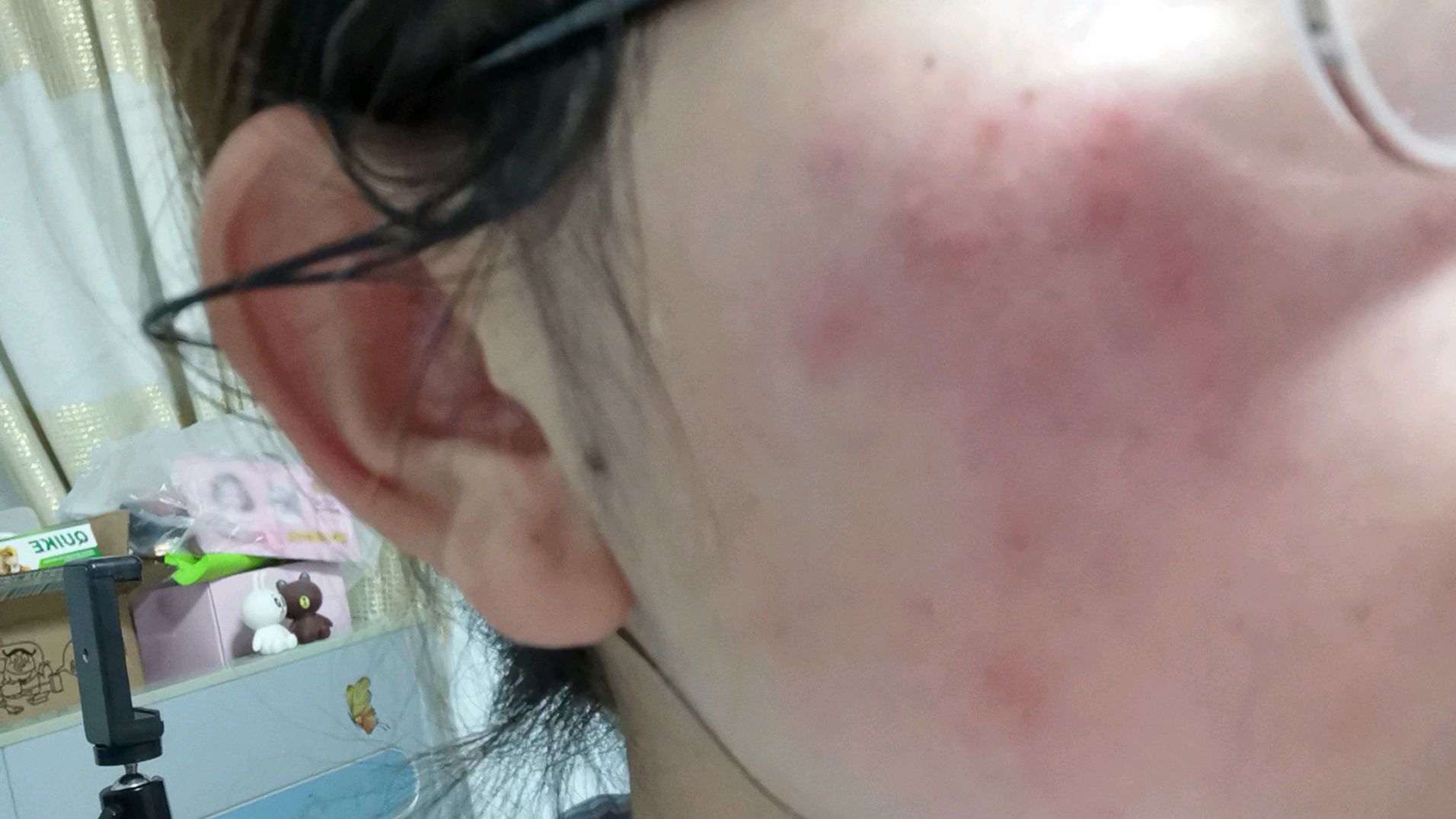 短短一个月过敏3次,小潘卸妆给大家看看有多严重,过敏源在哪?