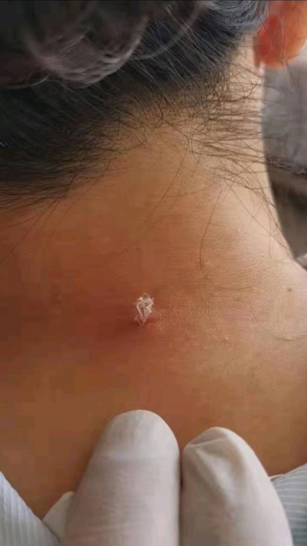 羊毛疔会引起富贵包吗