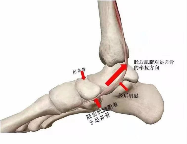 足副舟骨怎么消除疼痛图片